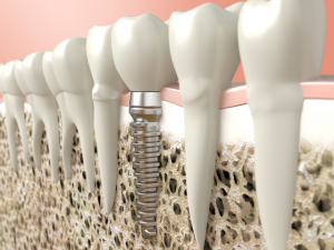 How much Does Dental Implant Cost