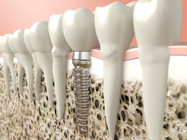 How much Does Dental Implant Cost