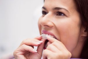 a girl is putting invisalign on her teeth