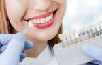 is dental bonding a good alternative to veneers for south edmonton patients