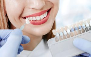 is dental bonding a good alternative to veneers for south edmonton patients