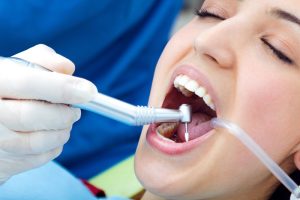 a lady is having latest dental filling treatment